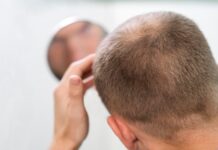 Is Finasteride the Long-Term Solution for Male Hair Loss? Male Hair Loss