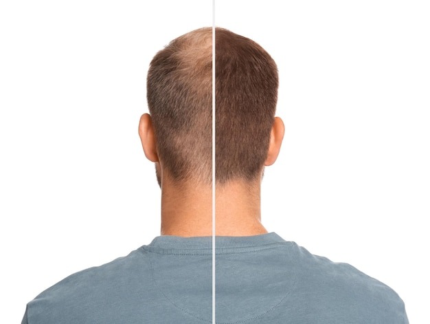 Pairing Finasteride with Other Treatments